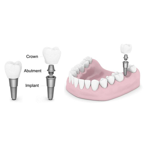 Dental Implant