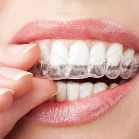 Invisalign Dentist