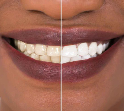 Teeth Whitening
